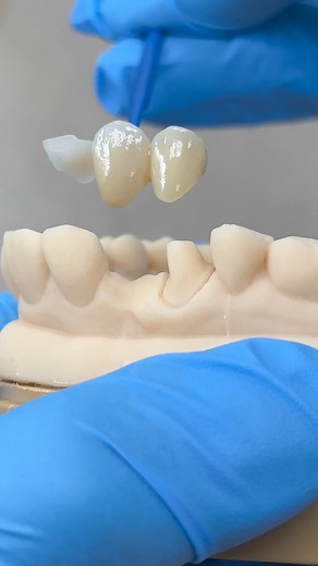 Zen Enamel Maryland Bridge! EnvisionTEC | Luke Kahng