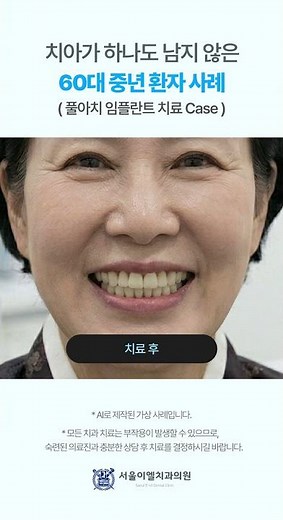 디오나비 풀아치 임플란트 치료 전, 후 결과 #전체임플란트 #풀아치임플란트