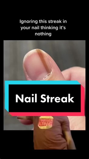 Understanding Melanonychia: Signs of Malignant Melanoma