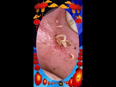 Blackheads Removal | Acne Treatment and Very Satisfying Satisfying Pimple pop #blackheads