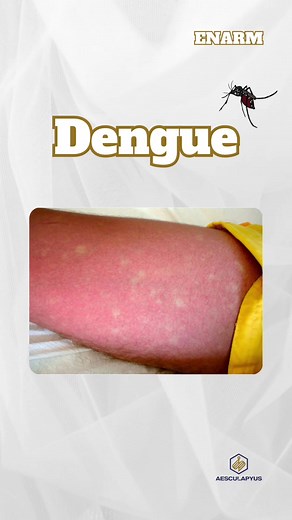 Repaso del Dengue: Síntomas, Fases y Tratamiento