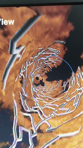 OCT Guided PCI To LAD#OCTGuidedPCI #LADStenting #InterventionalCardiology #OCTImaging #angioplasty