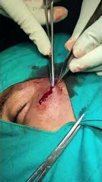 Scar Revision Treatment Explained | Dr. Suneel Kishore | Ongole