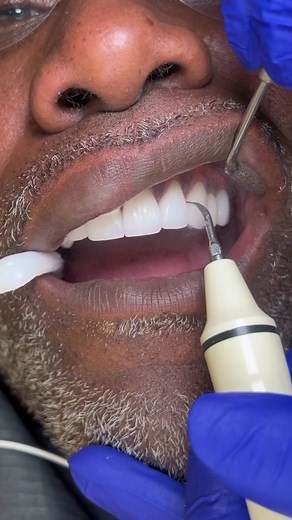 Cleaning Porcelain Veneers & Bridges - Dental Hygiene Tips