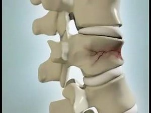 297 reactions · 349 shares | Vertebral Compression Fracture .. | Physiotherapy DPT | Facebook