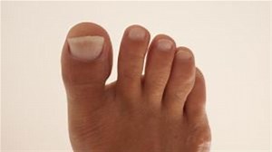 How To Manage A Broken Toe