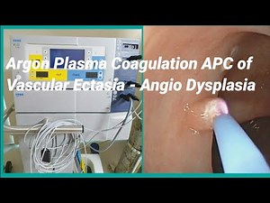 Angio Dysplasia or Vascular Ectasia Argon Plasma Coagulation APC - SQUARE HOSPITAL LTD #BD_ENDOSCOPY