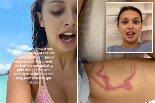 Influencer accidentally films herself being stung by deadly box jellyfish