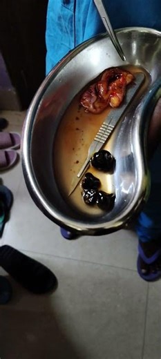 Gall bladder operation er por kotogulo boro stone বেরিয়েছে 🥺🥺