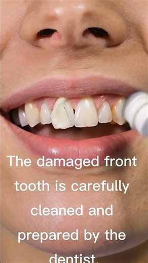 Macro View of Front Tooth Restoration | Amazing Smile Transformation