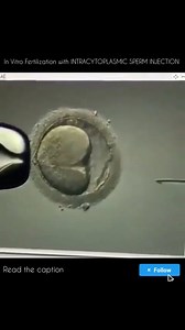 This is what IVF with ICSI (Intracytoplasmic Sperm Injection) looks like, a technique used in cases of infertility. During IVF, the egg is extracted from the woman's body and fertilised artificially "in vitro", the resulting embryo is kept in an incubator where it develops for 2-5 days, after which the embryo is transferred into the uterine cavity for further development. #anatomy #humananatomy #embryology #ivf #icsi #testtubebaby #instagram #reels #medicalstudent #mbbs | Medically True