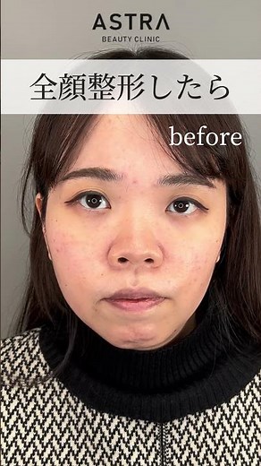 [What happened when I got full-face surgery...🫪 #forgettable-nose #rhinoplasty #KeikoShiomitsu #f...