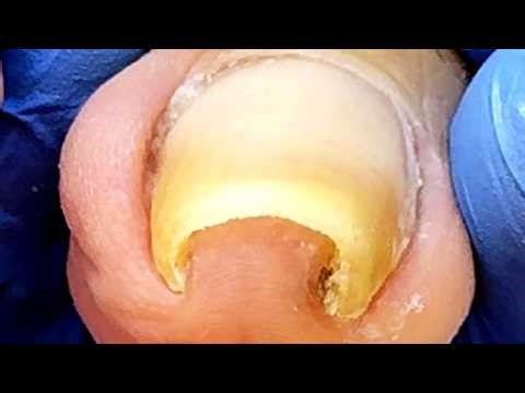Super Large Curly Ingrown Toenails, Cleanly Trimmed【Xue Yidao】