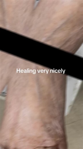 She had a total nail avulsion 2 weeks ago and is healing very nicely. After the scab falls off I will start her on a topical antifungal as the nail grows back in, hopefully thinner and healthier. 禮‍⚕️❤️‍啕 #toenail #fungalinfection #fungus #foot #podiatry | Dr. Jacqueline Sutera | Facebook