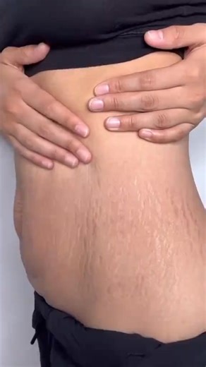 How to treat stretch marks naturally. How to treat stretch marks at home. #stretchmarktreatment #stretchmarks #skincare #naturalremedy #naturalrecipes | Natural Health | Facebook