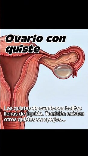 📣 OVARIAN CYSTS