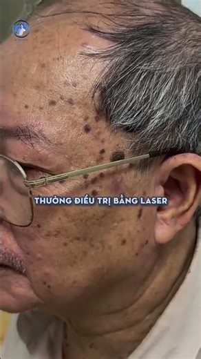 🔥 DÀY SỪNG DA DẦU – ĐỒI MỒI KHÔNG CHỈ DO TUỔI TÁC! 🔥