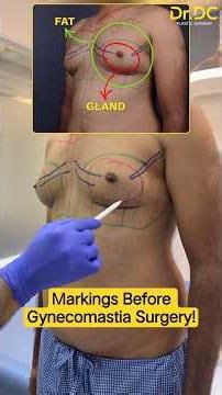 Watch The Exact Markings Before Gynecomastia Surgery! | Dr DC, Plastic Surgeon | India