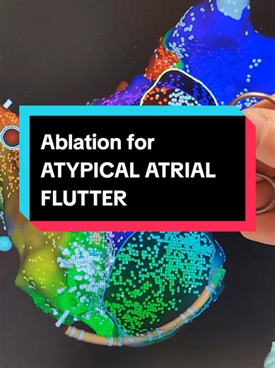 Catheter Ablation for AFIB: Mapping Heart Rhythms
