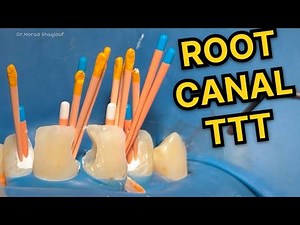 Anterior Teeth Root Canal Treatment