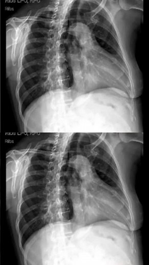 the X-Ray of the ribs left posterior oblique or right posterior oblique