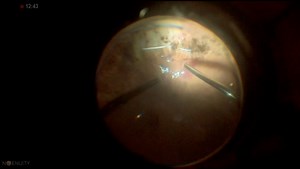 Recurrent Retinal Detachment Under Silicone Oil - Eyetube