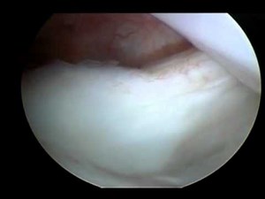 Canine Medial Shoulder Instability Arthroscopy