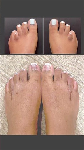 THE BRACHYBALANCING ™️ SURGERY FOR BRACHYMETATARSIA ❤️‍🔥 #brachymetatarsia #braquimetatarsia