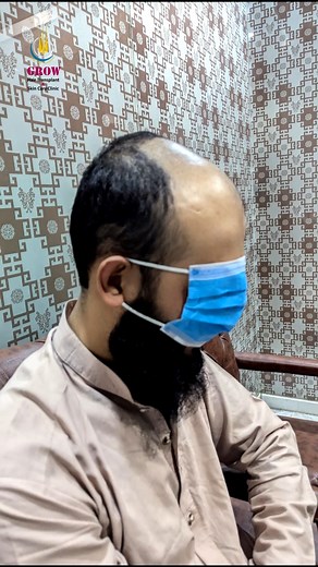 3K views · 28 reactions | Grow Hair Transplant || 6000 Grafts #hairtransformation #hairgraft #GrowHairTransplant #hairtransplant #FUEHairTransplant #fuehairtransplantation | Grow Hair Transplant & Dental Centre | Facebook