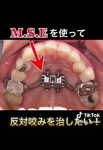 反対咬合がワイヤー矯正のみで綺麗に治りました🦷✨#矯正 #矯正治療 #歯医者 #歯科医院 #矯正歯科 #ワイヤー矯正 #インビザライン矯正 #マウスピース矯正 #三重矯正 #鈴鹿矯正 #大木歯科医院