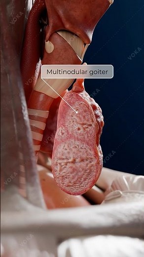 Multinodular Goiter Explained: Thyroid Enlargement, Symptoms & Compression Signs | 3D Animation