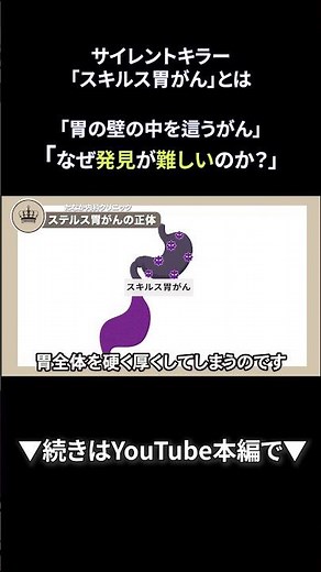 42 サイレントキラー「スキルス胃がんとは」? 初期症状と早期発見の重要性｜たなか内科クリニック #shorts