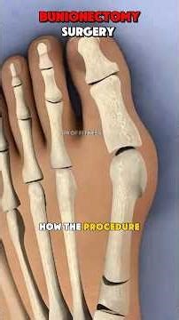 How Bunionectomy Surgery Is Done(3D Animation)#footsurgery #medicalanimation #3danimation