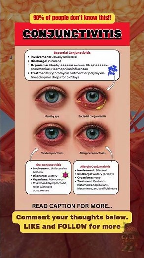 Conjunctivitis (Pink Eye): Viral, Bacterial, and Allergic — Causes, Symptoms and Treatment Explained