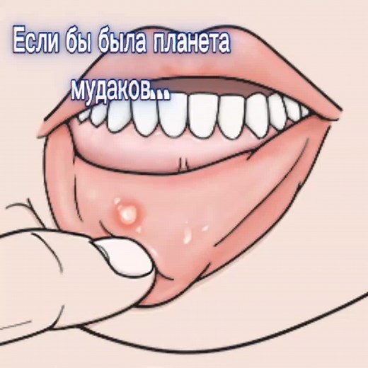 Афтозный стоматит: причины и лечение