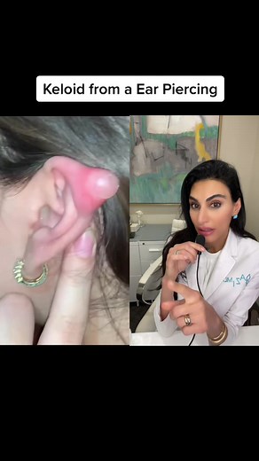 Keloid Removal: Dermatologist Reacts to Ear Piercing Keloid