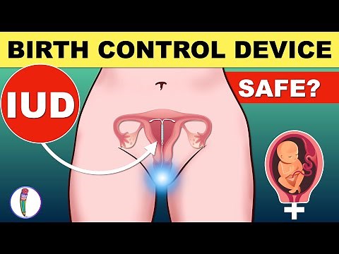Intrauterine Device (IUD) For Pregnancy Control | IUD Insertion | Birth Control