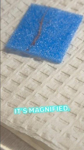 Prostate biopsy; what does it look like?