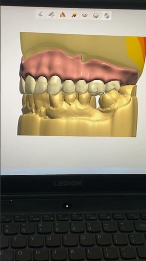 Full denture design by 3shape