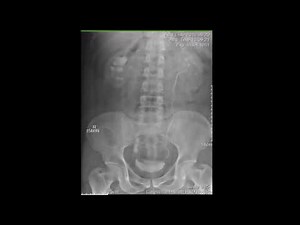 CASE 222 IVP immediate dense peristent nephrogram
