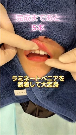 歯の表面に薄いセラミックを貼り、色味や形の改善を行う施術になります🙂‍↕️🦷💎#ラミネートベニア