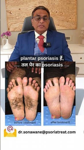 Plantar Psoriasis Feet Treatment | प्लांटर सोरयासिस