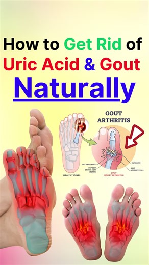 Effective Natural Remedies for Uric Acid and Gout