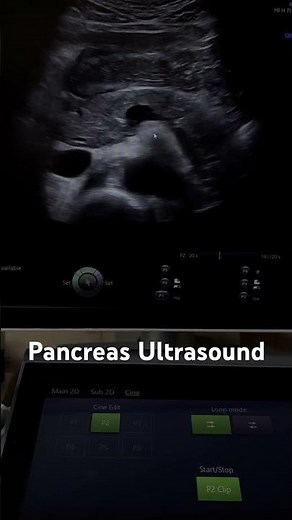 Pancreas Ultrasound | Normal Structures