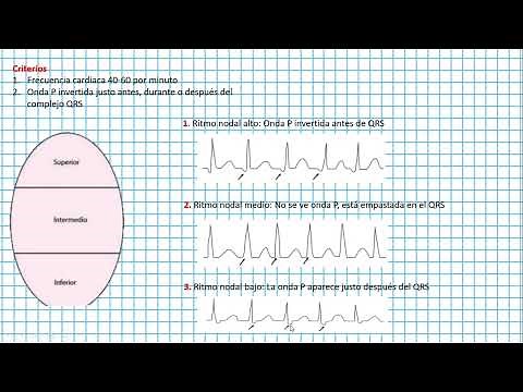 Ritmo NODAL o ritmo de la UNION ( Clases EKG #35)
