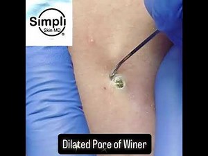 Dilated Pore of Winer Extraction