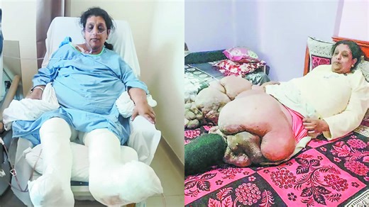 Atteinte d’éléphantiasis - Pushpa Devi : 50 kilos de souffrance en moins