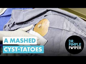 A Mashed Cyst-Tatoes