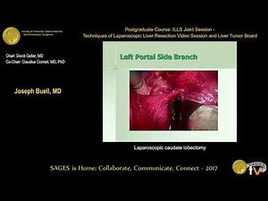 Laparoscopic Caudate Lobectomy • Video • MEDtube.net