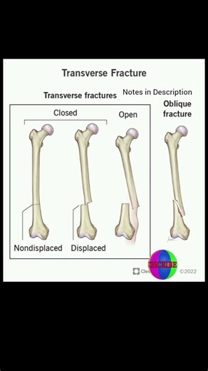 what is transverse fracture #trending #neet #youtubeshorts #biology #bones #fracture #anatomy #notes